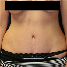 Tummy Tuck After Photo by Steve Laverson, MD, FACS; Rancho Santa Fe, CA - Case 40690