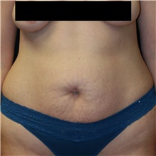 Tummy Tuck Before Photo by Steve Laverson, MD, FACS; Rancho Santa Fe, CA - Case 40690