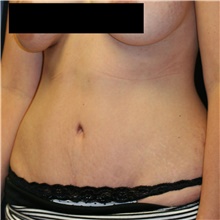 Tummy Tuck After Photo by Steve Laverson, MD, FACS; Rancho Santa Fe, CA - Case 40690