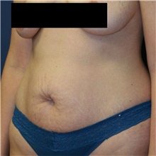 Tummy Tuck Before Photo by Steve Laverson, MD, FACS; Rancho Santa Fe, CA - Case 40690