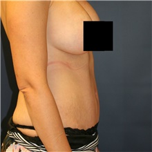 Tummy Tuck After Photo by Steve Laverson, MD, FACS; Rancho Santa Fe, CA - Case 40690