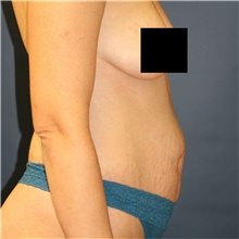 Tummy Tuck Before Photo by Steve Laverson, MD, FACS; Rancho Santa Fe, CA - Case 40690