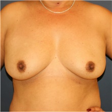 Breast Augmentation Before Photo by Steve Laverson, MD; San Diego, CA - Case 40711