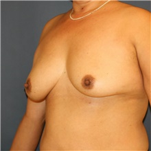 Breast Augmentation Before Photo by Steve Laverson, MD, FACS; San Diego, CA - Case 40711