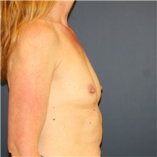 Breast Augmentation Before Photo by Steve Laverson, MD, FACS; Rancho Santa Fe, CA - Case 40712