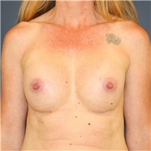 Breast Augmentation After Photo by Steve Laverson, MD, FACS; Rancho Santa Fe, CA - Case 40712