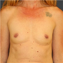 Breast Augmentation Before Photo by Steve Laverson, MD, FACS; Rancho Santa Fe, CA - Case 40712