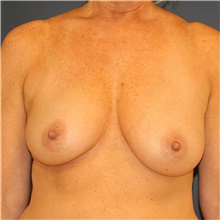 Breast Lift Before Photo by Steve Laverson, MD, FACS; Rancho Santa Fe, CA - Case 40725