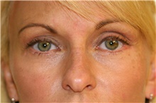 Eyelid Surgery After Photo by Steve Laverson, MD, FACS; Rancho Santa Fe, CA - Case 40726