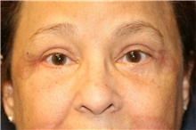Eyelid Surgery After Photo by Steve Laverson, MD; San Diego, CA - Case 40746