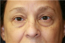 Eyelid Surgery Before Photo by Steve Laverson, MD; San Diego, CA - Case 40746