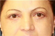 Eyelid Surgery After Photo by Steve Laverson, MD; San Diego, CA - Case 40747