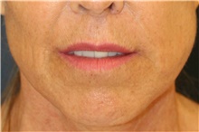 Lip Augmentation/Enhancement After Photo by Steve Laverson, MD, FACS; Rancho Santa Fe, CA - Case 40791