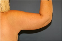 Arm Lift After Photo by Steve Laverson, MD, FACS; San Diego, CA - Case 40809