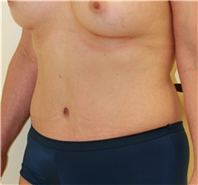 Tummy Tuck After Photo by Steve Laverson, MD; San Diego, CA - Case 40831