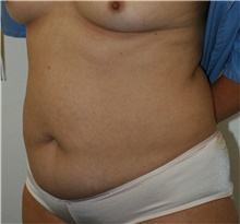 Tummy Tuck Before Photo by Steve Laverson, MD; San Diego, CA - Case 40831