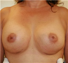 Breast Augmentation After Photo by Steve Laverson, MD, FACS; Rancho Santa Fe, CA - Case 40851