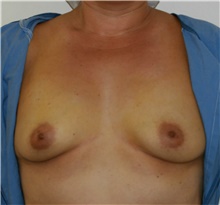 Breast Augmentation Before Photo by Steve Laverson, MD, FACS; Rancho Santa Fe, CA - Case 40851