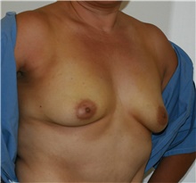 Breast Augmentation Before Photo by Steve Laverson, MD, FACS; Rancho Santa Fe, CA - Case 40851