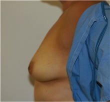 Breast Augmentation Before Photo by Steve Laverson, MD, FACS; Rancho Santa Fe, CA - Case 40851