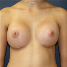 Breast Augmentation After Photo by Steve Laverson, MD, FACS; Rancho Santa Fe, CA - Case 40852