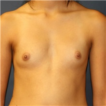 Breast Augmentation Before Photo by Steve Laverson, MD, FACS; Rancho Santa Fe, CA - Case 40852