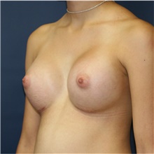 Breast Augmentation After Photo by Steve Laverson, MD, FACS; Rancho Santa Fe, CA - Case 40852