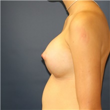 Breast Augmentation After Photo by Steve Laverson, MD, FACS; Rancho Santa Fe, CA - Case 40852