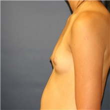 Breast Augmentation Before Photo by Steve Laverson, MD, FACS; Rancho Santa Fe, CA - Case 40852