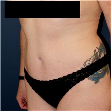 Tummy Tuck After Photo by Steve Laverson, MD, FACS; San Diego, CA - Case 40858