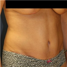 Tummy Tuck After Photo by Steve Laverson, MD, FACS; Rancho Santa Fe, CA - Case 40863