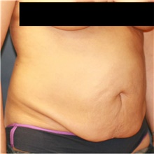 Tummy Tuck Before Photo by Steve Laverson, MD, FACS; Rancho Santa Fe, CA - Case 40863