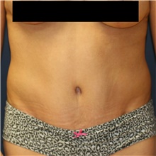 Tummy Tuck After Photo by Steve Laverson, MD, FACS; Rancho Santa Fe, CA - Case 40863