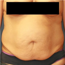 Tummy Tuck Before Photo by Steve Laverson, MD, FACS; Rancho Santa Fe, CA - Case 40863