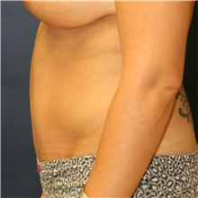 Tummy Tuck After Photo by Steve Laverson, MD, FACS; Rancho Santa Fe, CA - Case 40863