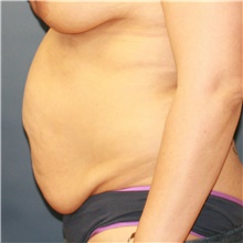 Tummy Tuck Before Photo by Steve Laverson, MD, FACS; Rancho Santa Fe, CA - Case 40863