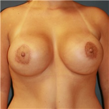 Breast Lift After Photo by Steve Laverson, MD, FACS; Rancho Santa Fe, CA - Case 40867