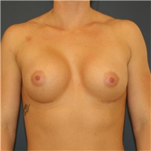 Breast Augmentation After Photo by Steve Laverson, MD, FACS; Rancho Santa Fe, CA - Case 40889