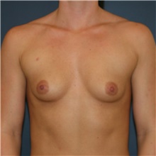 Breast Augmentation Before Photo by Steve Laverson, MD, FACS; Rancho Santa Fe, CA - Case 40889