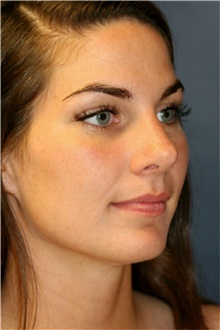 Rhinoplasty After Photo by Steve Laverson, MD, FACS; Rancho Santa Fe, CA - Case 40898