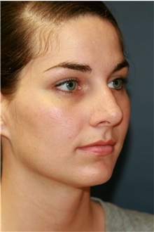 Rhinoplasty Before Photo by Steve Laverson, MD, FACS; Rancho Santa Fe, CA - Case 40898