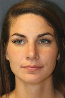 Rhinoplasty After Photo by Steve Laverson, MD, FACS; Rancho Santa Fe, CA - Case 40898