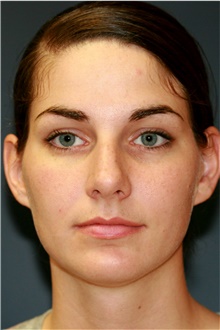 Rhinoplasty Before Photo by Steve Laverson, MD, FACS; Rancho Santa Fe, CA - Case 40898