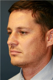 Rhinoplasty Before Photo by Steve Laverson, MD, FACS; Rancho Santa Fe, CA - Case 40899