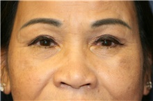 Eyelid Surgery After Photo by Steve Laverson, MD; San Diego, CA - Case 40900