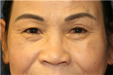 Eyelid Surgery Before Photo by Steve Laverson, MD; San Diego, CA - Case 40900