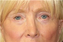 Eyelid Surgery After Photo by Steve Laverson, MD, FACS; Rancho Santa Fe, CA - Case 40901