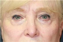 Eyelid Surgery Before Photo by Steve Laverson, MD, FACS; Rancho Santa Fe, CA - Case 40901