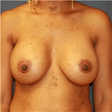 Breast Augmentation After Photo by Steve Laverson, MD, FACS; Rancho Santa Fe, CA - Case 40907