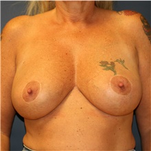 Breast Reduction After Photo by Steve Laverson, MD, FACS; Rancho Santa Fe, CA - Case 40919